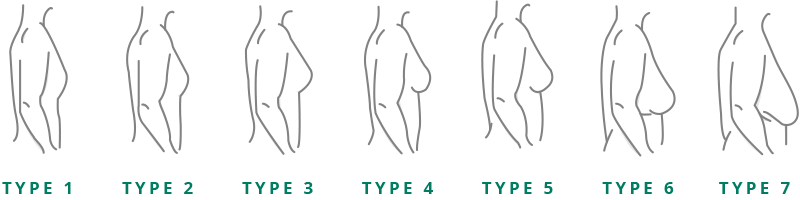 Seven Gynecomastia Types